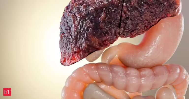 Fatty liver new treatment found: Study discovers a medicine that reverses severe fatty liver by just repairing the gut